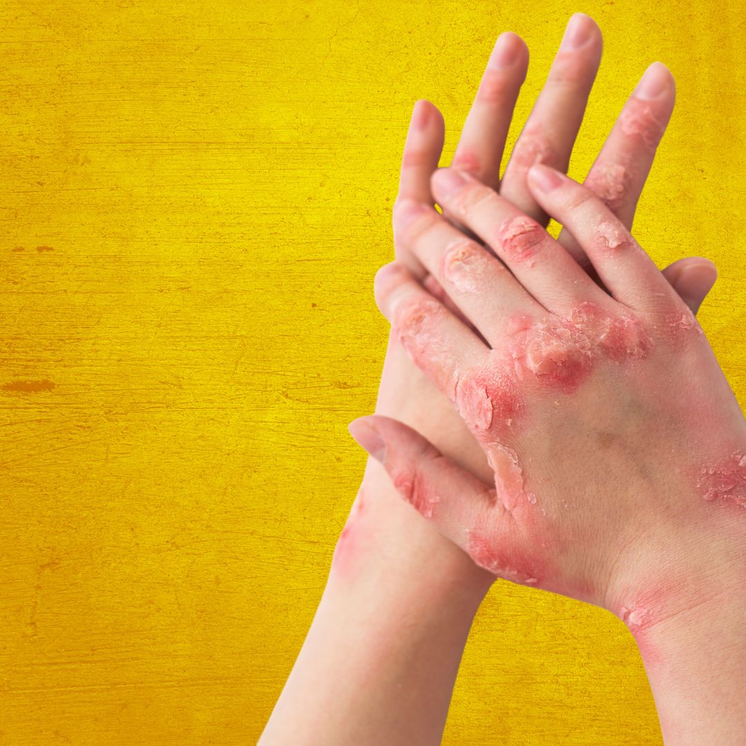 Le psoriasis - Causes, conséquences et traitements